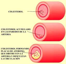 Dislipemia 