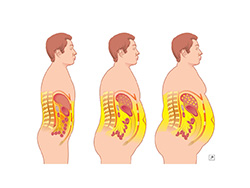 Obesidad y sobrepeso